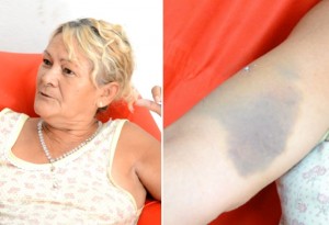 Dona Maria do Socorro mostra hematoma no braço