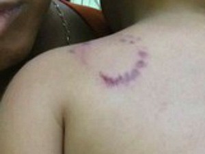 Criança apresenta marcas de mordida em diferentes partes do corpo (Foto: Divulgação)