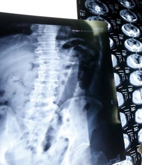 Exames de raios-X revelaram a presença do vibrador no corpo (Foto: reprodução) 